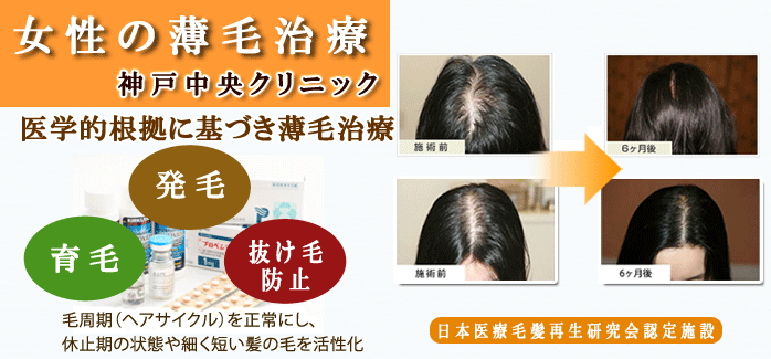 女性の薄毛治療-神戸中央クリニック